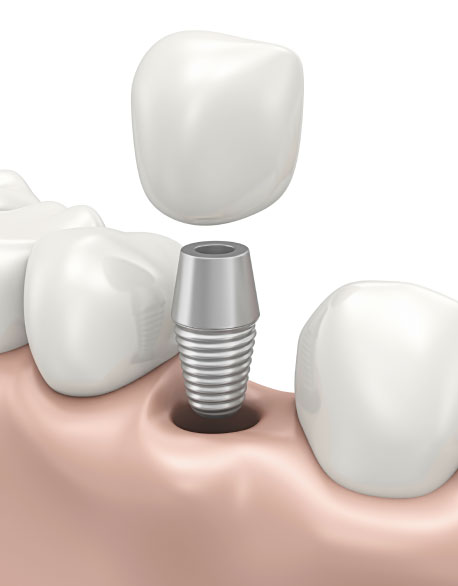 dental implant Long Island