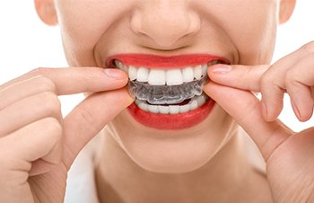 Invisalign Teeth Straightening