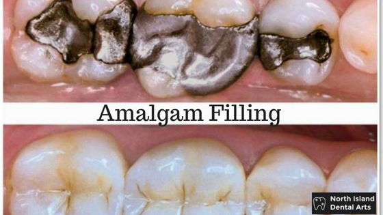 Amalgam Filling