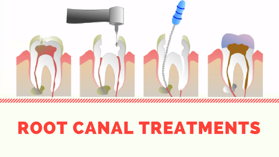 Root Canal Treatments Long Island
