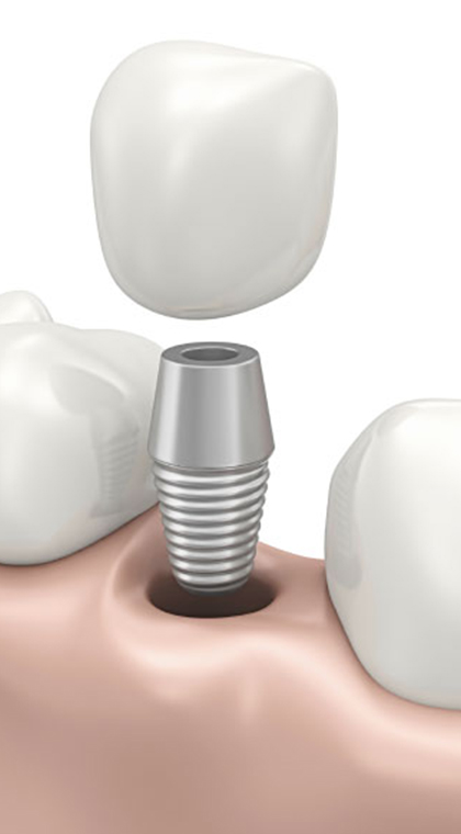 Dental Implants Treatment in Long Island 